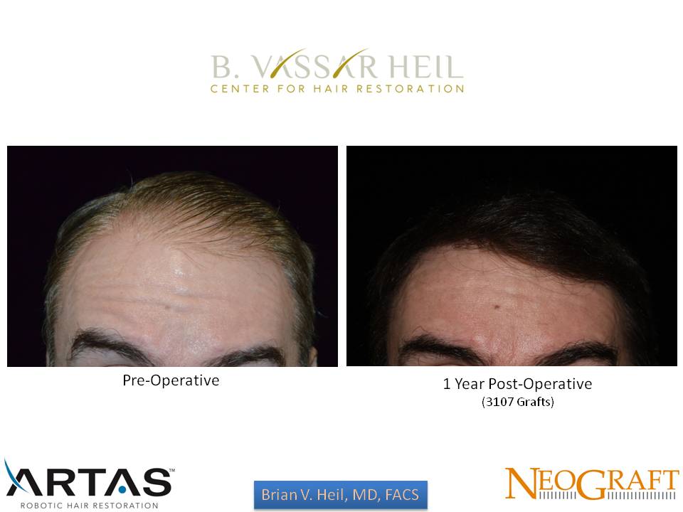 Hair Restoration Before and After | Premier Plastic Surgery