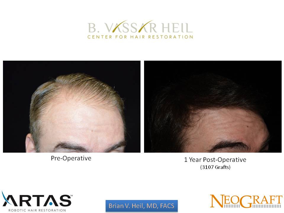 Hair Restoration Before and After | Premier Plastic Surgery