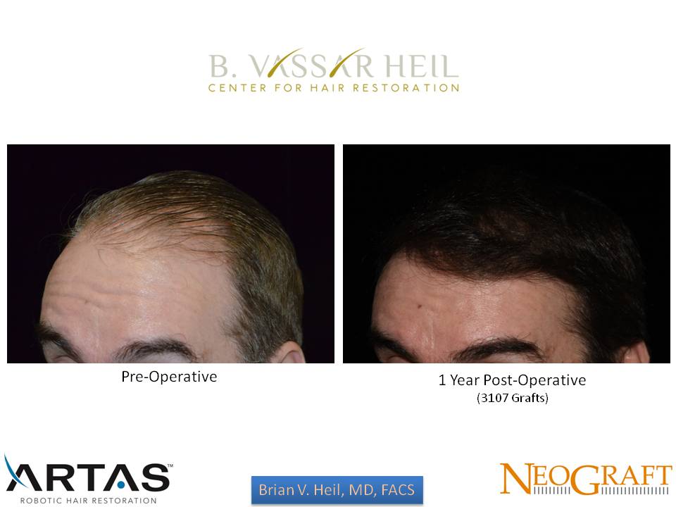 Hair Restoration Before and After | Premier Plastic Surgery