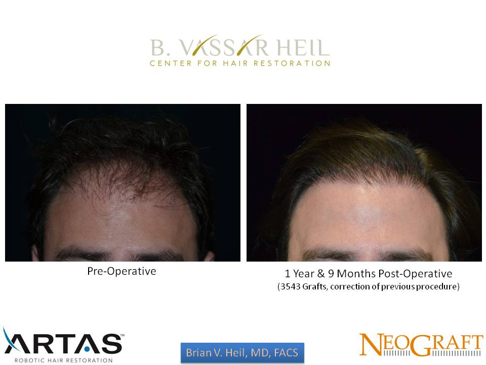 Hair Restoration Before and After | Premier Plastic Surgery