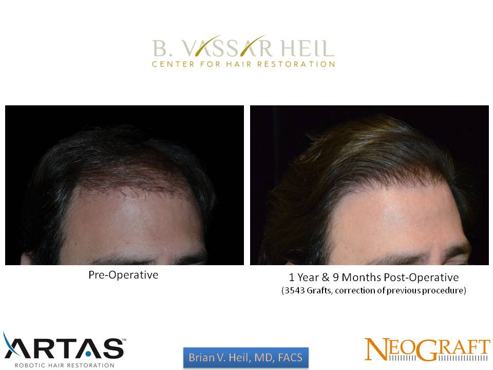 Hair Restoration Before and After | Premier Plastic Surgery