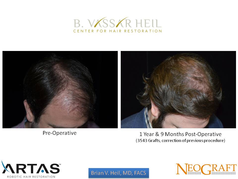 Hair Restoration Before and After | Premier Plastic Surgery