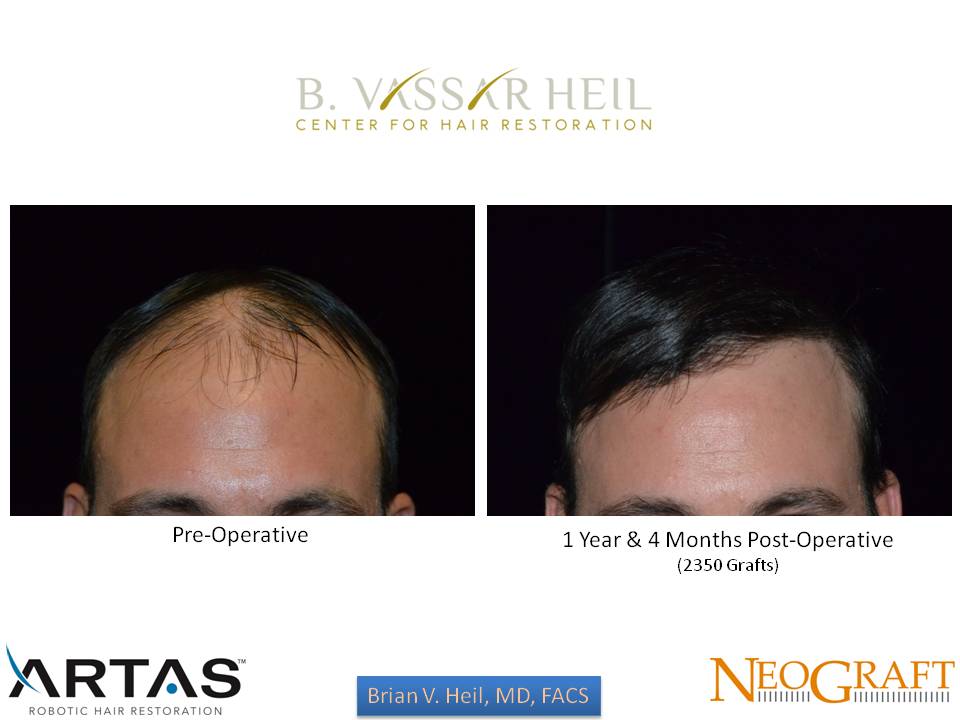 Hair Restoration Before and After | Premier Plastic Surgery