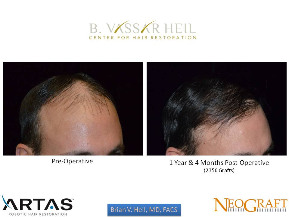 Hair Restoration Before and After | Premier Plastic Surgery