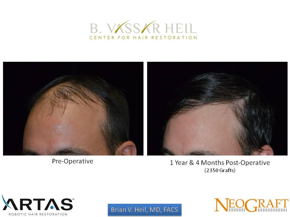 Hair Restoration Before and After | Premier Plastic Surgery