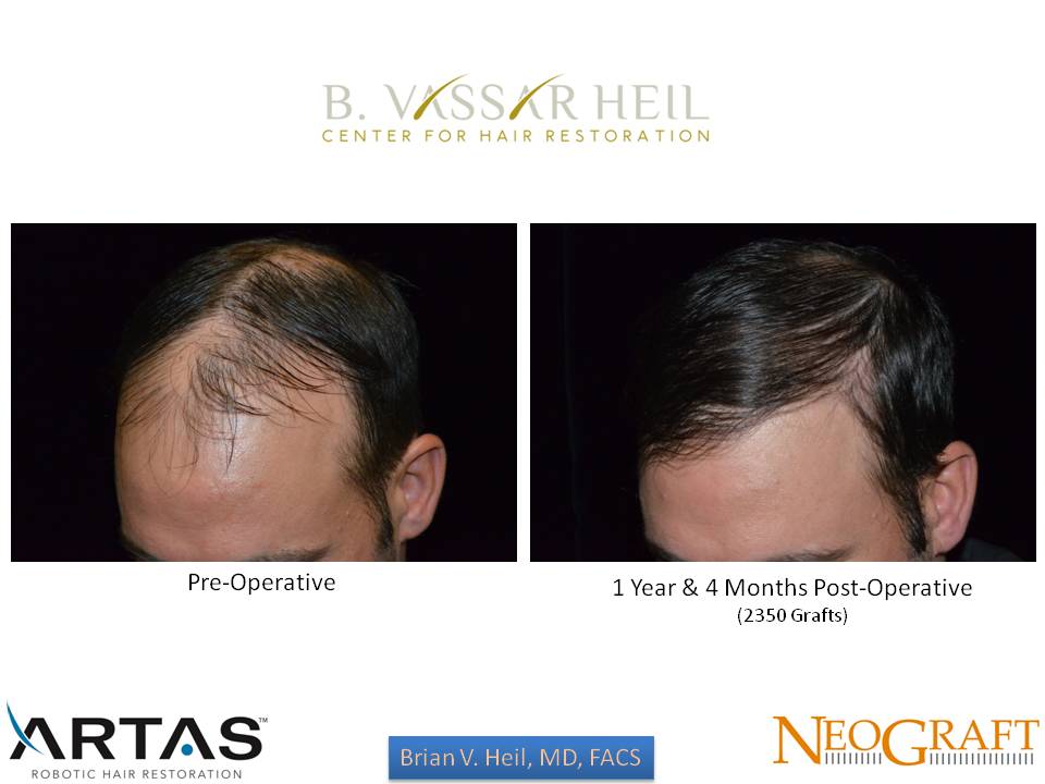 Hair Restoration Before and After | Premier Plastic Surgery