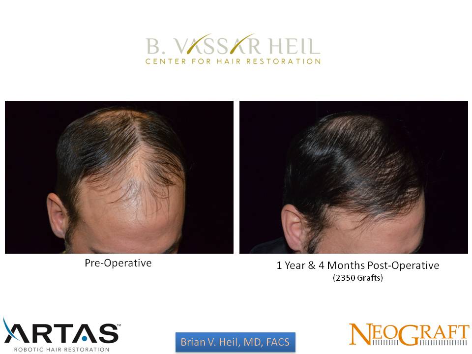 Hair Restoration Before and After | Premier Plastic Surgery