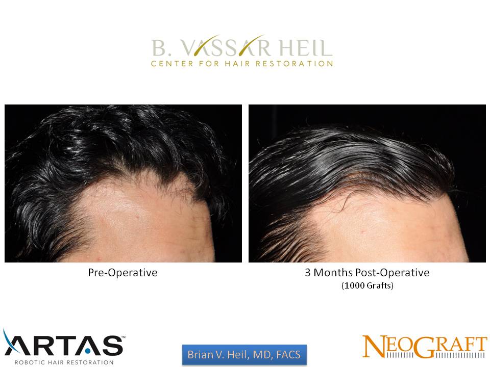 Hair Restoration Before and After | Premier Plastic Surgery