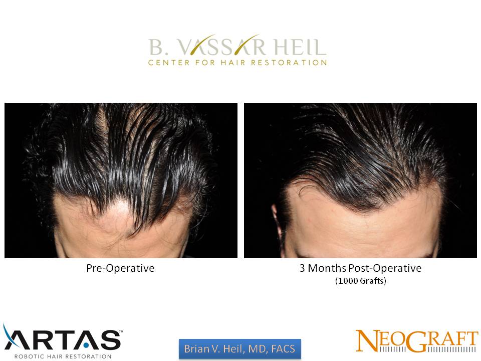 Hair Restoration Before and After | Premier Plastic Surgery