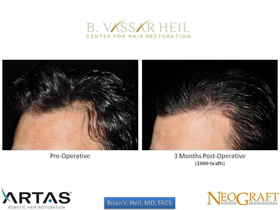 Hair Restoration Before and After | Premier Plastic Surgery