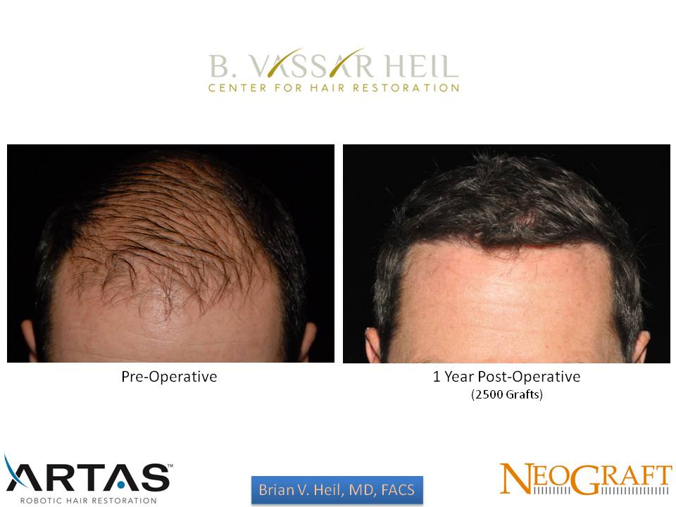 Hair Restoration Before and After | Premier Plastic Surgery