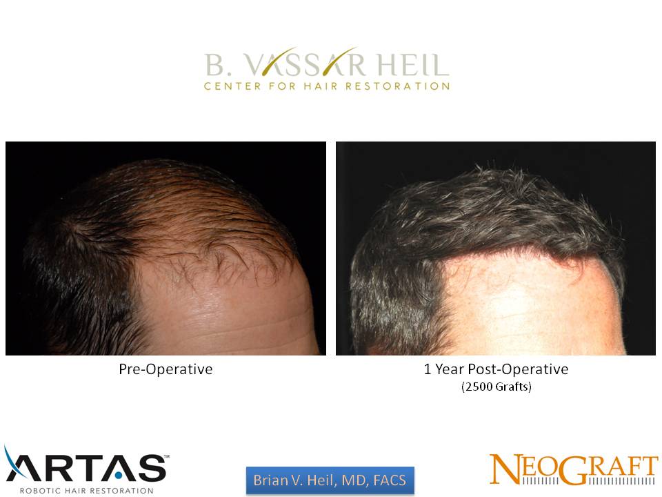 Hair Restoration Before and After | Premier Plastic Surgery