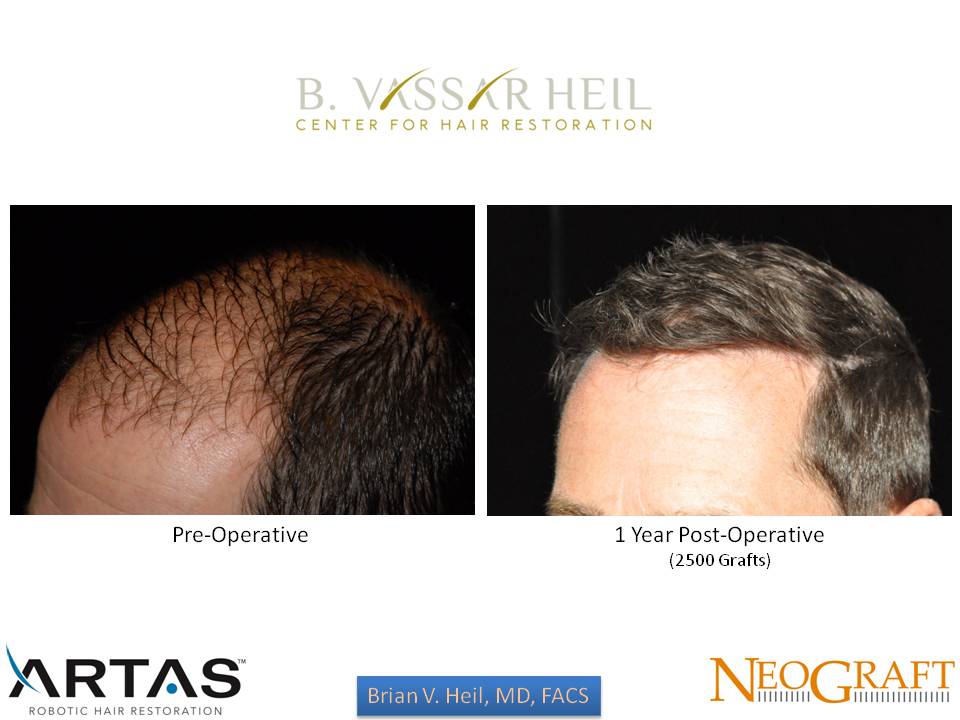 Hair Restoration Before and After | Premier Plastic Surgery