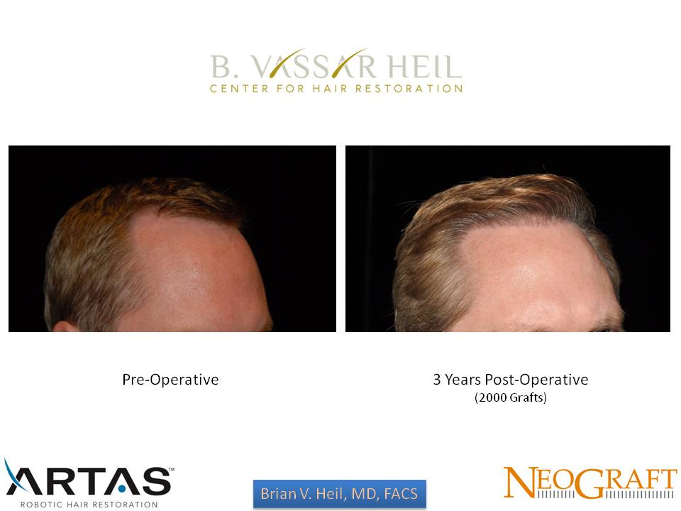 Hair Restoration Before and After | Premier Plastic Surgery