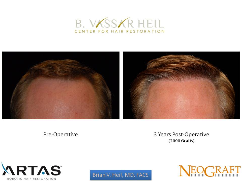 Hair Restoration Before and After | Premier Plastic Surgery