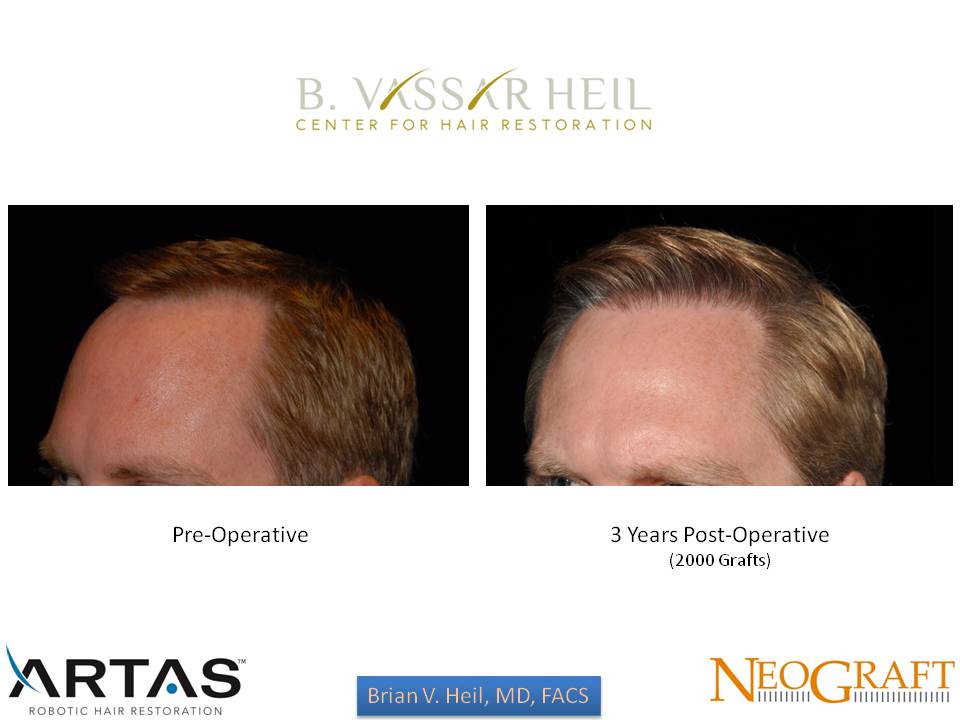 Hair Restoration Before and After | Premier Plastic Surgery