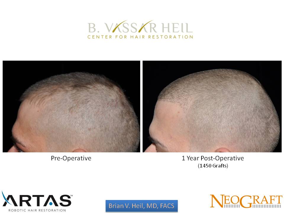 Hair Restoration Before and After | Premier Plastic Surgery