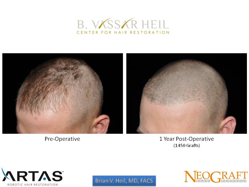 Hair Restoration Before and After | Premier Plastic Surgery