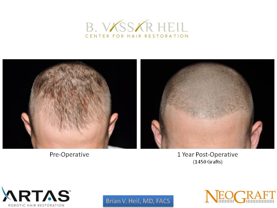 Hair Restoration Before and After | Premier Plastic Surgery