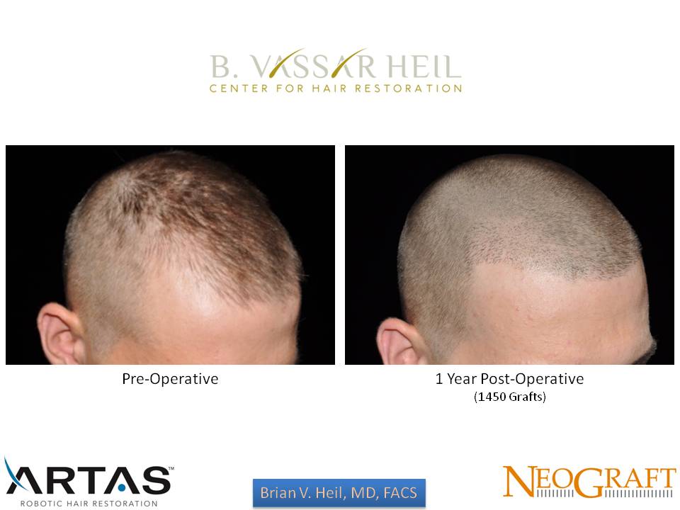 Hair Restoration Before and After | Premier Plastic Surgery