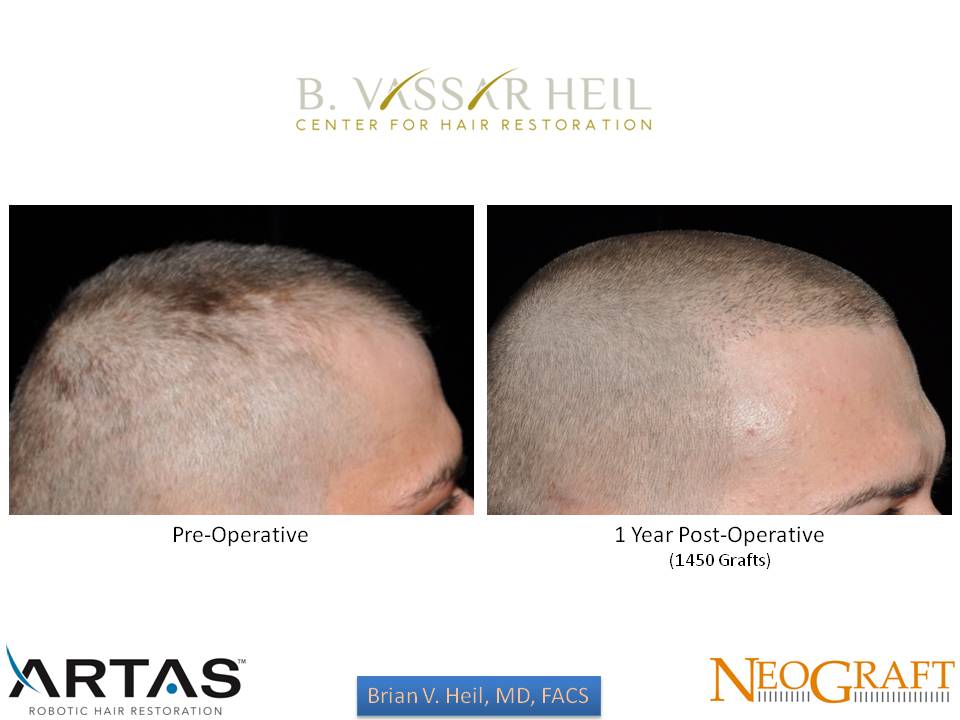 Hair Restoration Before and After | Premier Plastic Surgery