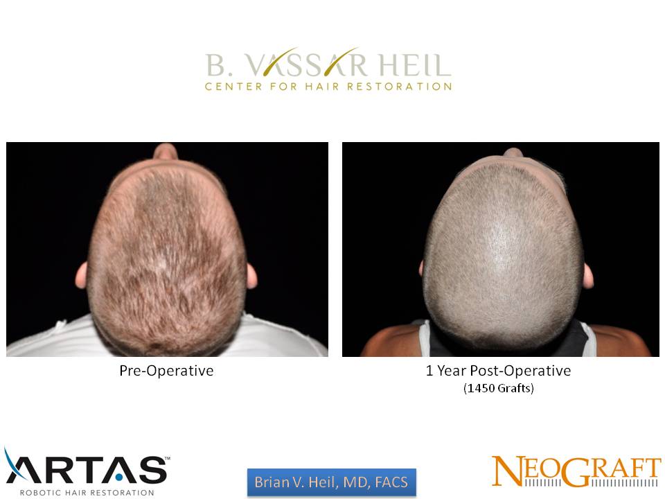 Hair Restoration Before and After | Premier Plastic Surgery