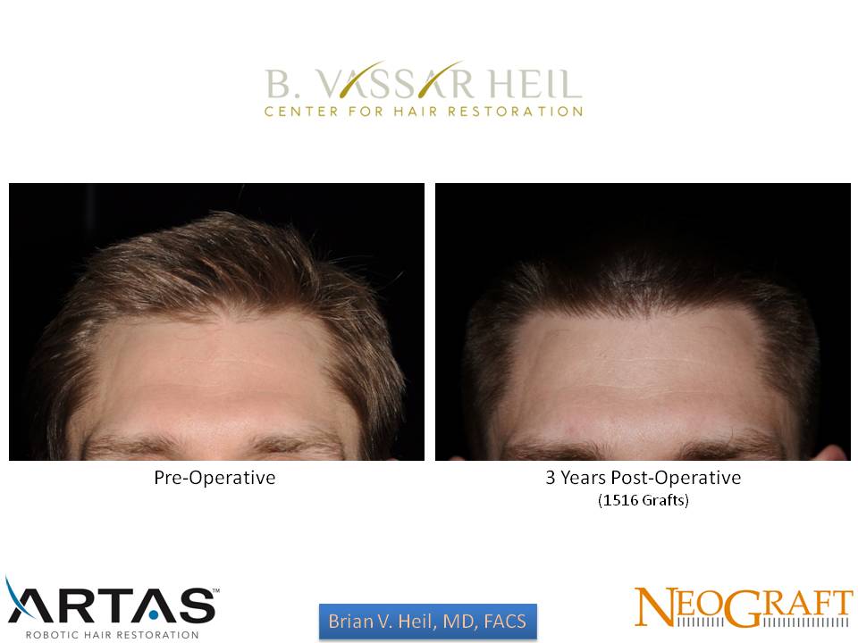 Hair Restoration Before and After | Premier Plastic Surgery