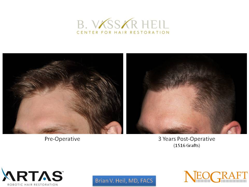 Hair Restoration Before and After | Premier Plastic Surgery