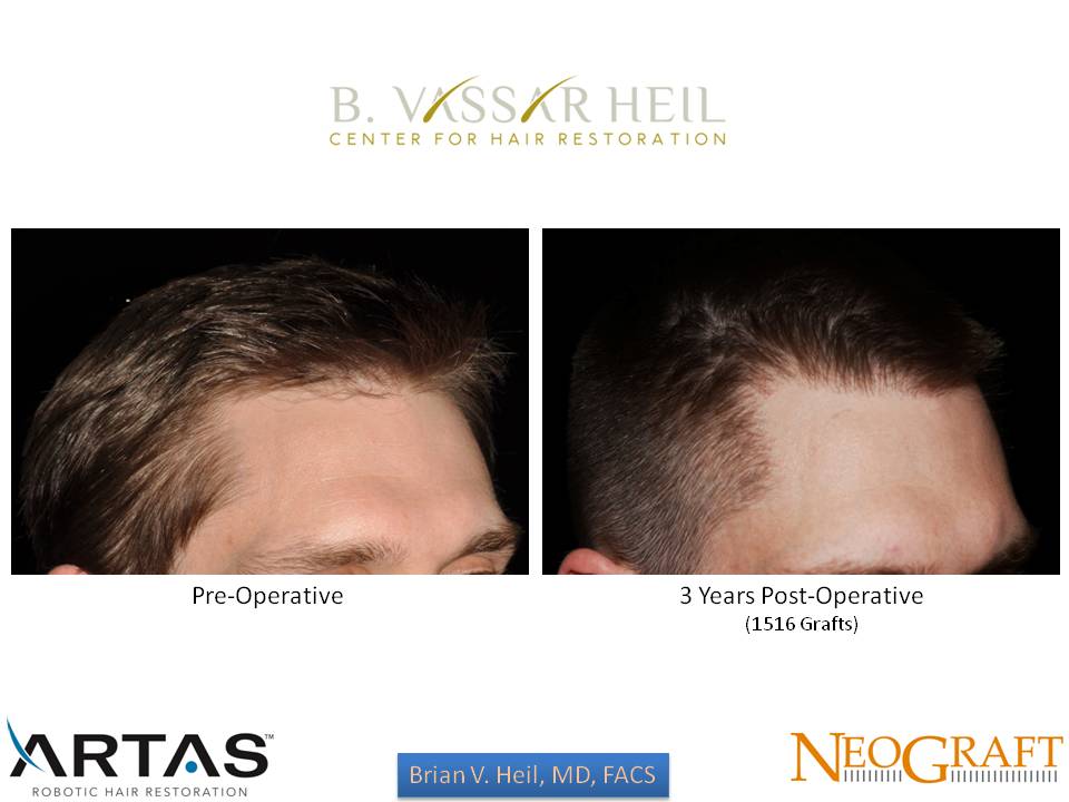 Hair Restoration Before and After | Premier Plastic Surgery