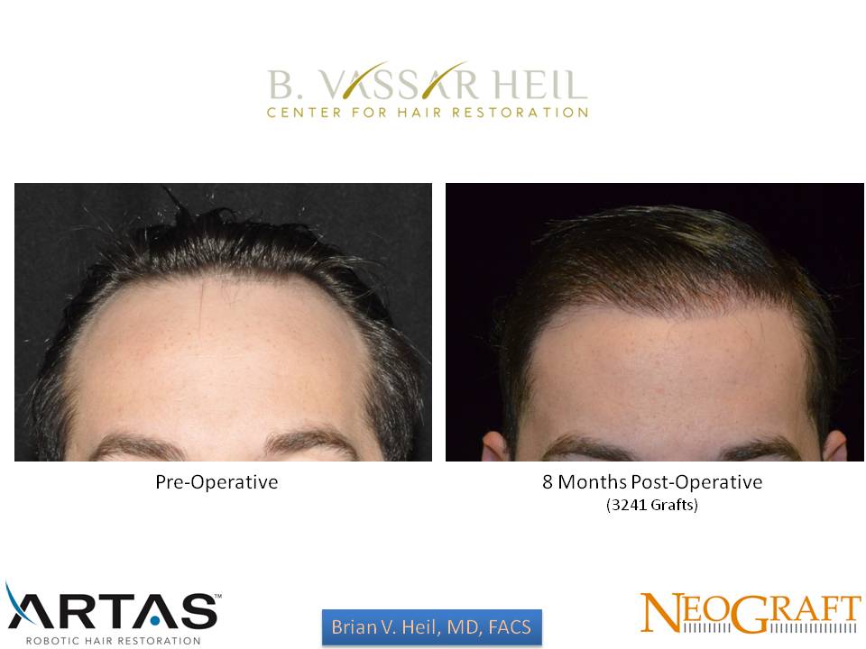 Hair Restoration Before and After | Premier Plastic Surgery