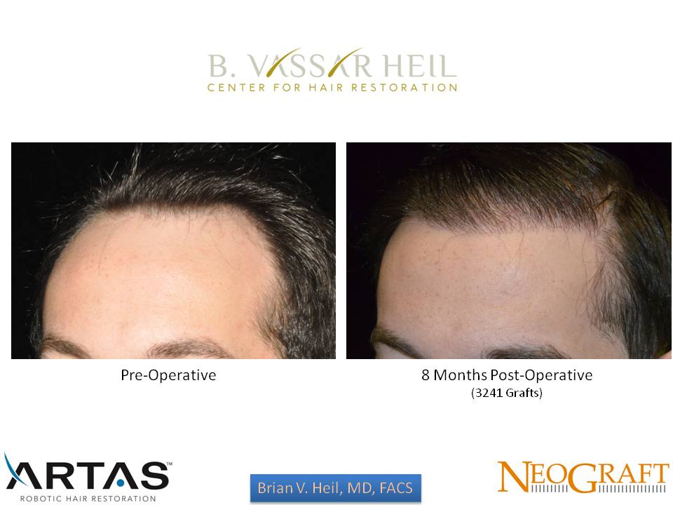 Hair Restoration Before and After | Premier Plastic Surgery