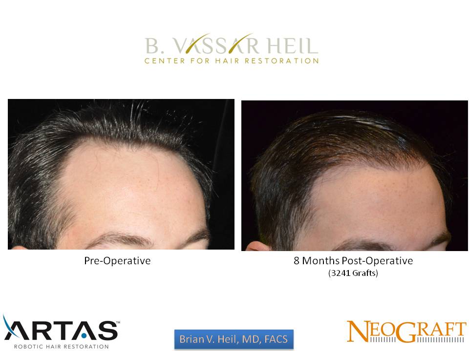 Hair Restoration Before and After | Premier Plastic Surgery