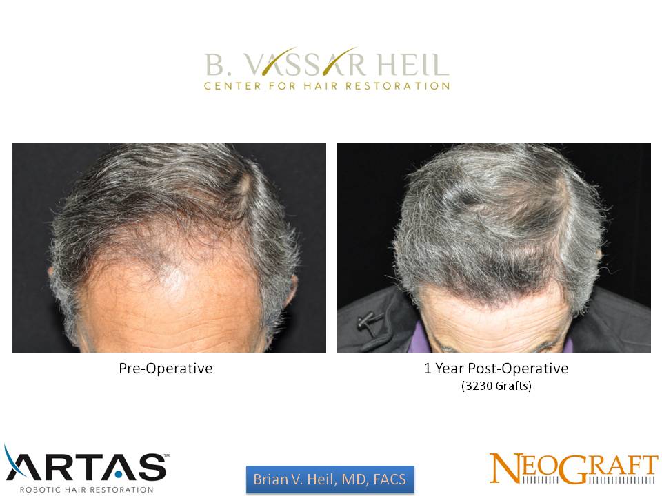 Hair Restoration Before and After | Premier Plastic Surgery