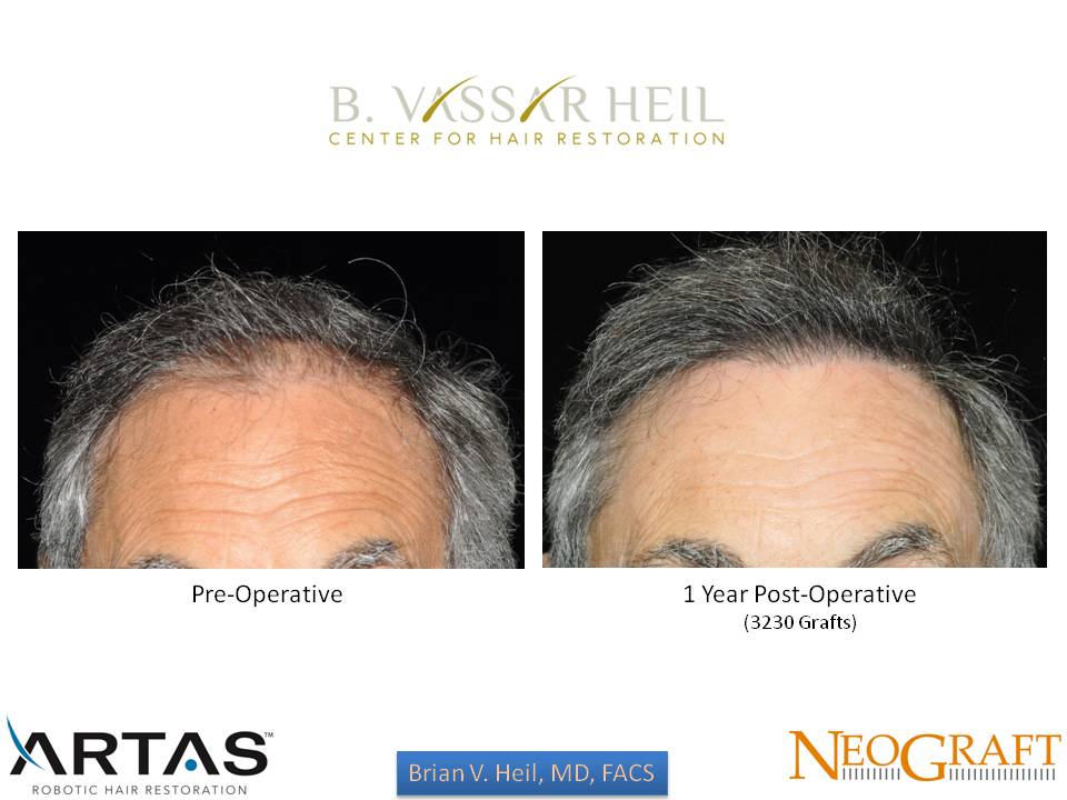 Hair Restoration Before and After | Premier Plastic Surgery