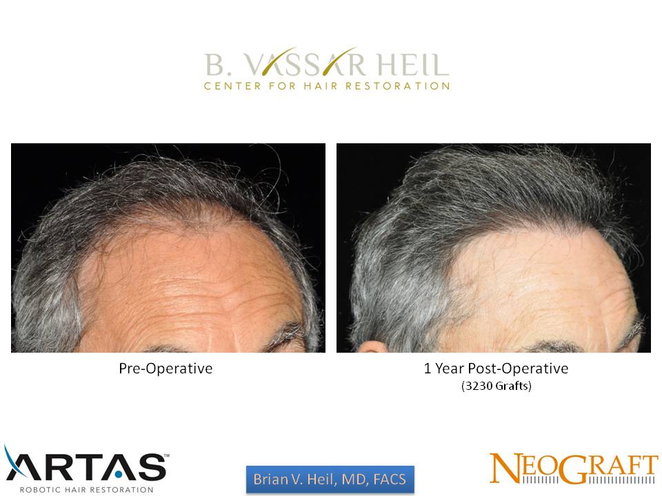 Hair Restoration Before and After | Premier Plastic Surgery