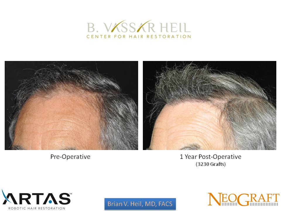 Hair Restoration Before and After | Premier Plastic Surgery