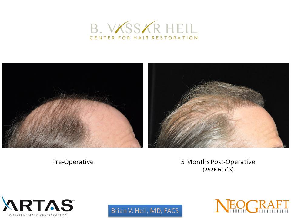 Hair Restoration Before and After | Premier Plastic Surgery