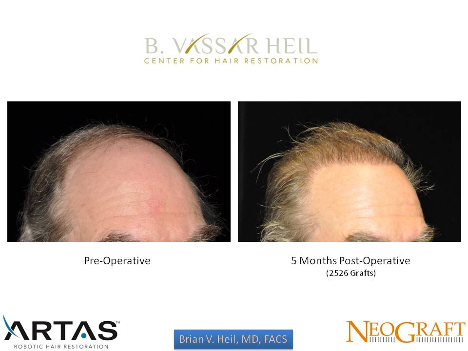 Hair Restoration Before and After | Premier Plastic Surgery