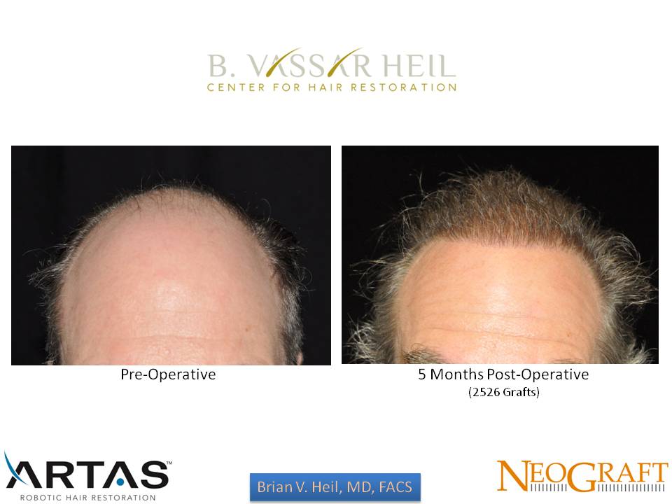 Hair Restoration Before and After | Premier Plastic Surgery