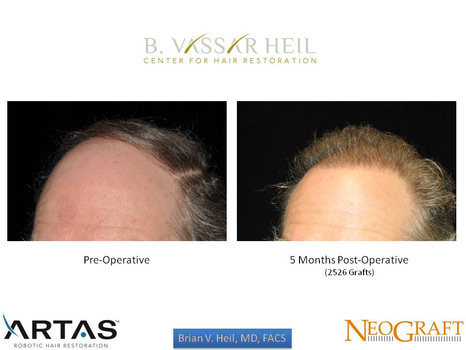 Hair Restoration Before and After | Premier Plastic Surgery