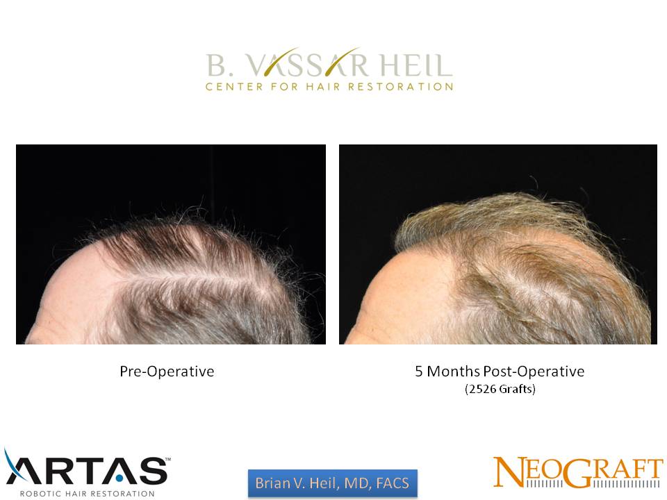 Hair Restoration Before and After | Premier Plastic Surgery