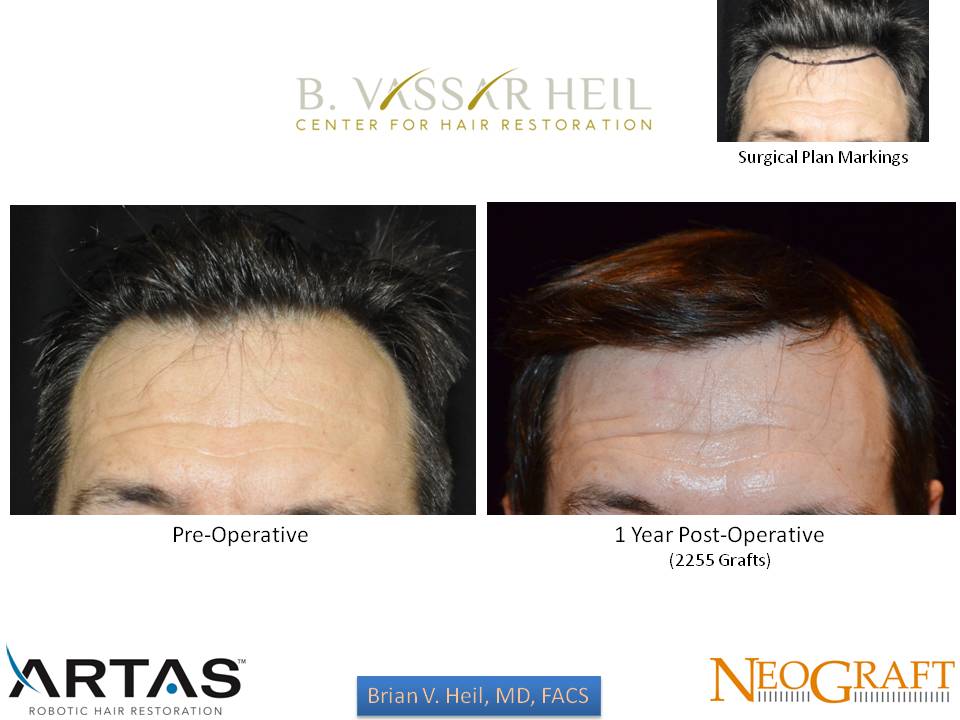 Hair Restoration Before and After | Premier Plastic Surgery