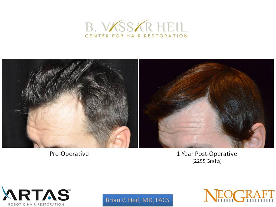 Hair Restoration Before and After | Premier Plastic Surgery