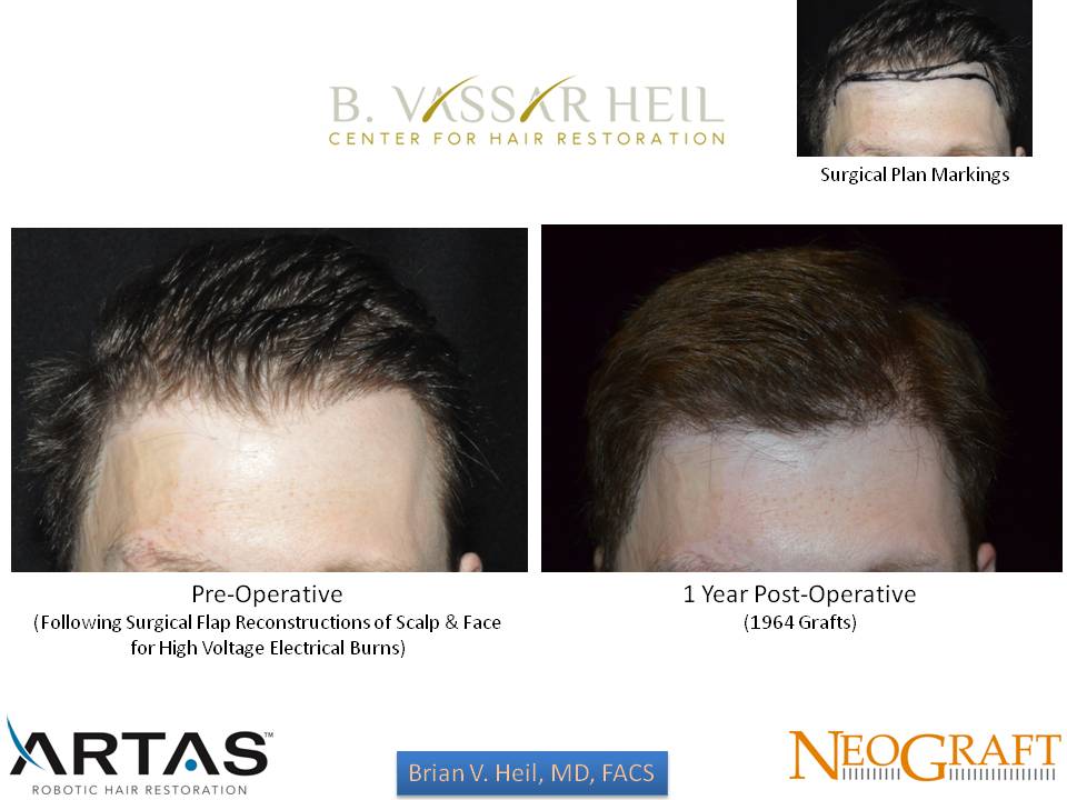 Hair Restoration Before and After | Premier Plastic Surgery