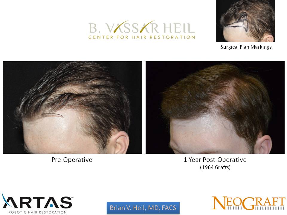 Hair Restoration Before and After | Premier Plastic Surgery