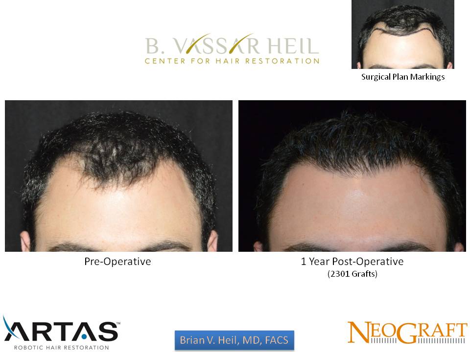 Hair Restoration Before and After | Premier Plastic Surgery