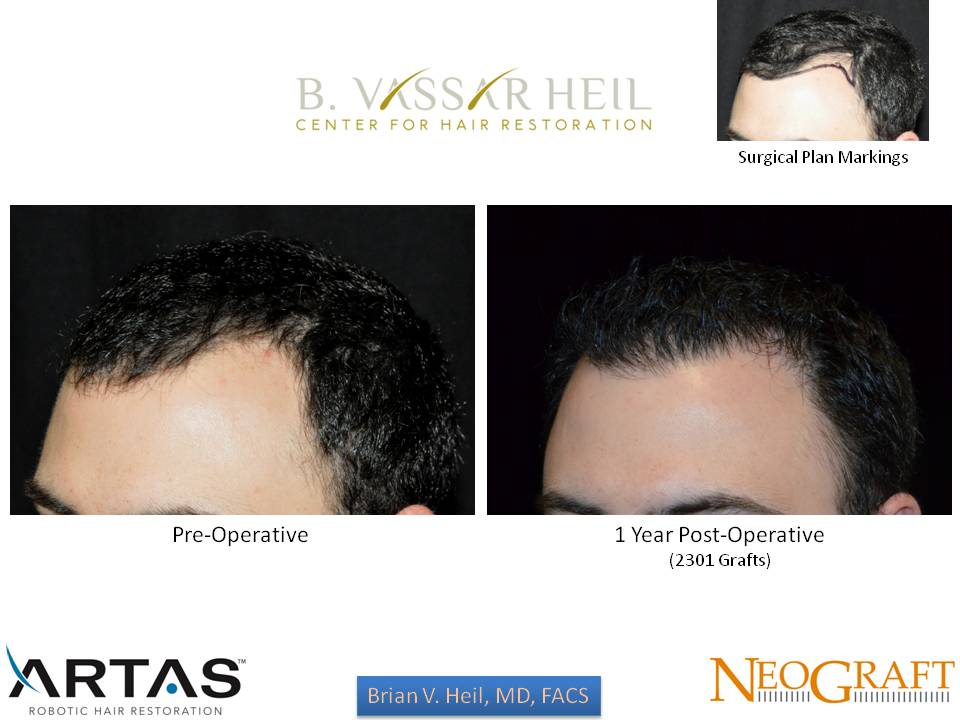 Hair Restoration Before and After | Premier Plastic Surgery