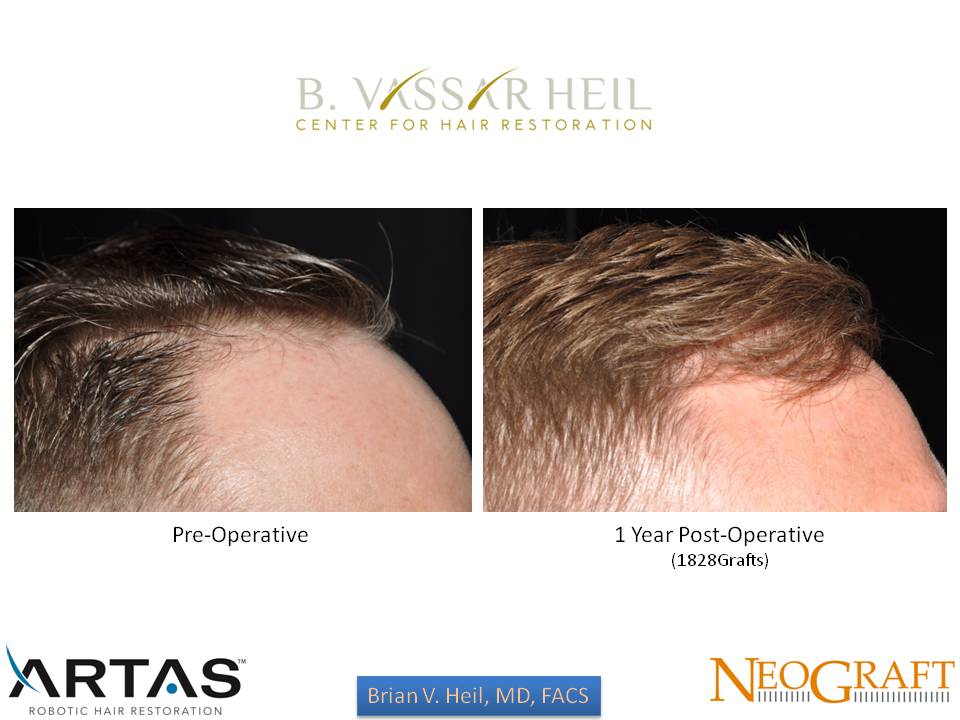 Hair Restoration Before and After | Premier Plastic Surgery