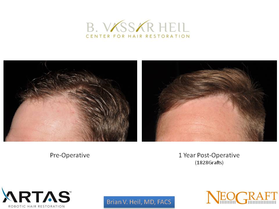 Hair Restoration Before and After | Premier Plastic Surgery