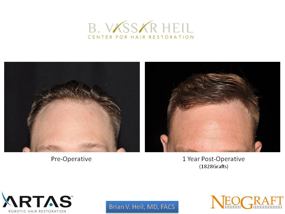 Hair Restoration Before and After | Premier Plastic Surgery